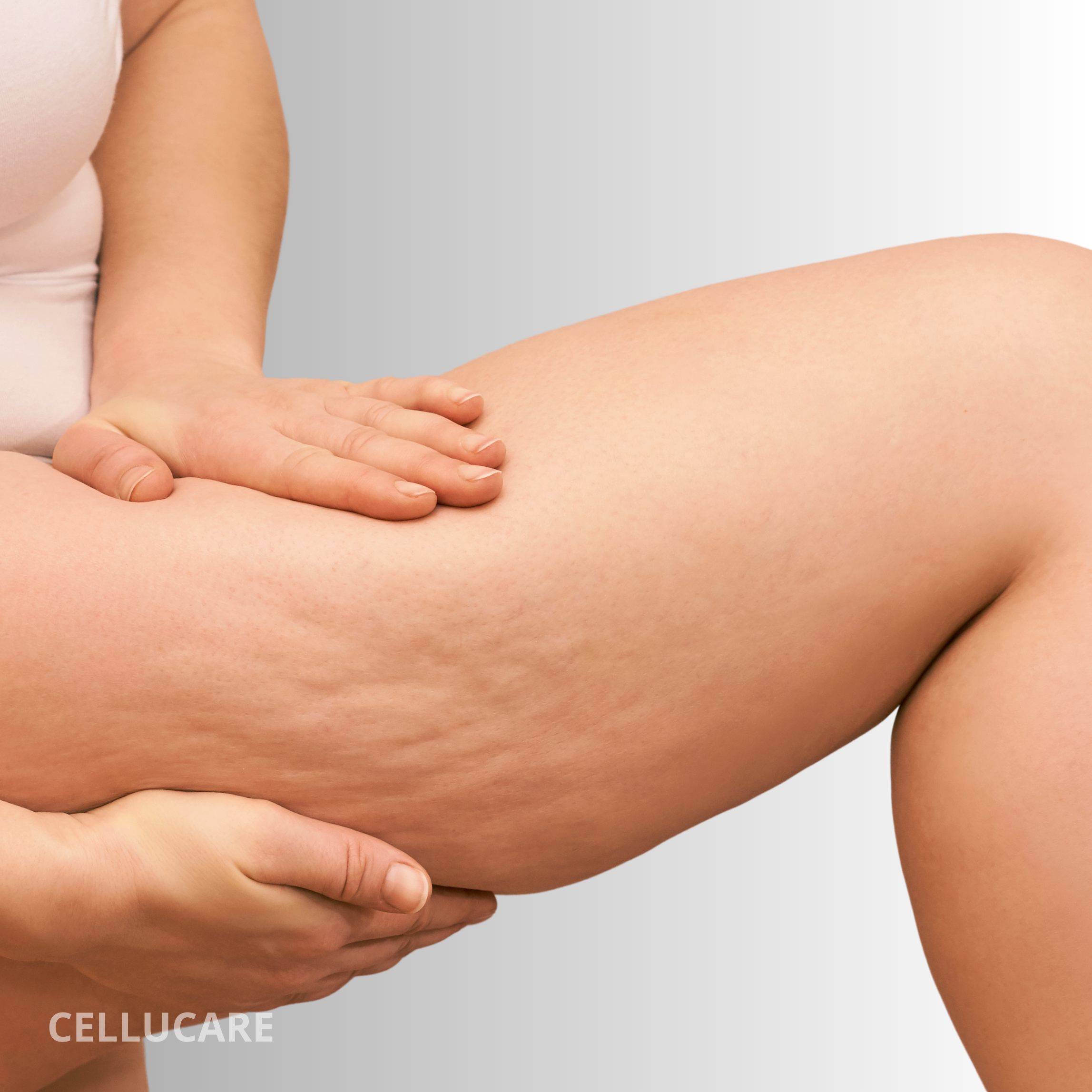 Los tipos de celulitis que existen y por qué aparecen